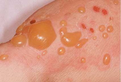 bullous pemphigoid blisters and skin rash