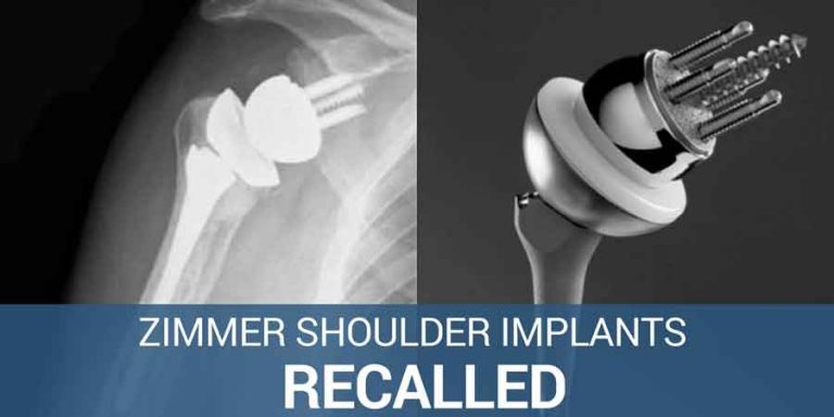 Zimmer Shoulder Implants FDA fast tracked after recall