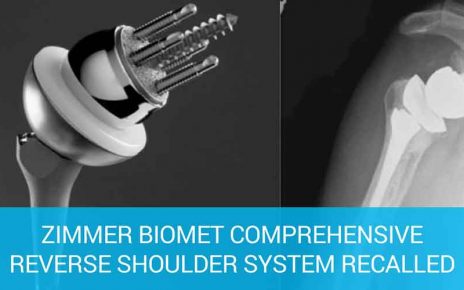 Zimmer Shoulder Replacement