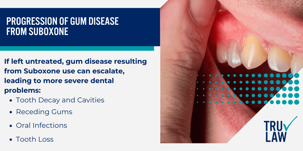 Risk Factors for Developing Gum Disease from Suboxone; Progression of Gum Disease from Suboxone
